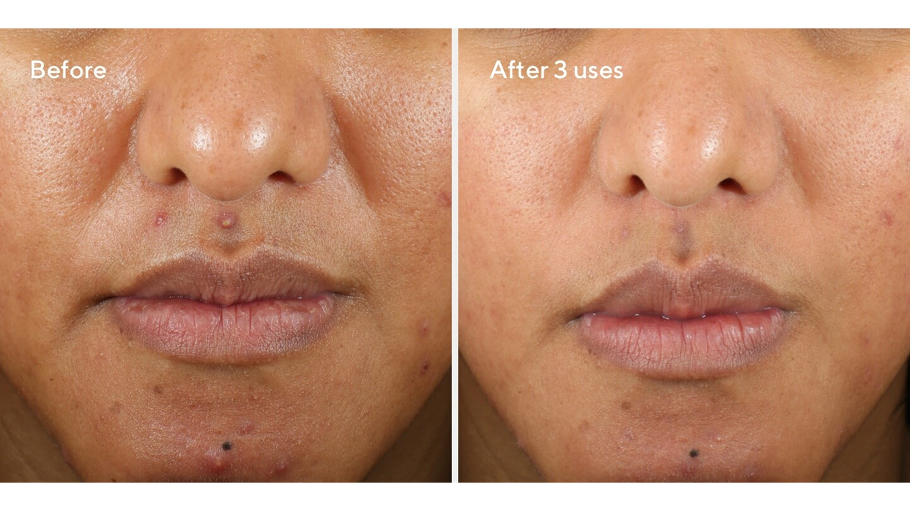 Murad BLEMISH CONTROL Rapid Relief Sulfur Mask