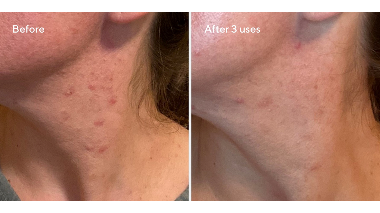 Murad BLEMISH CONTROL Rapid Relief Sulfur Mask